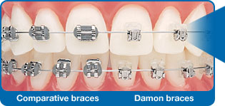 damon-braces.jpg